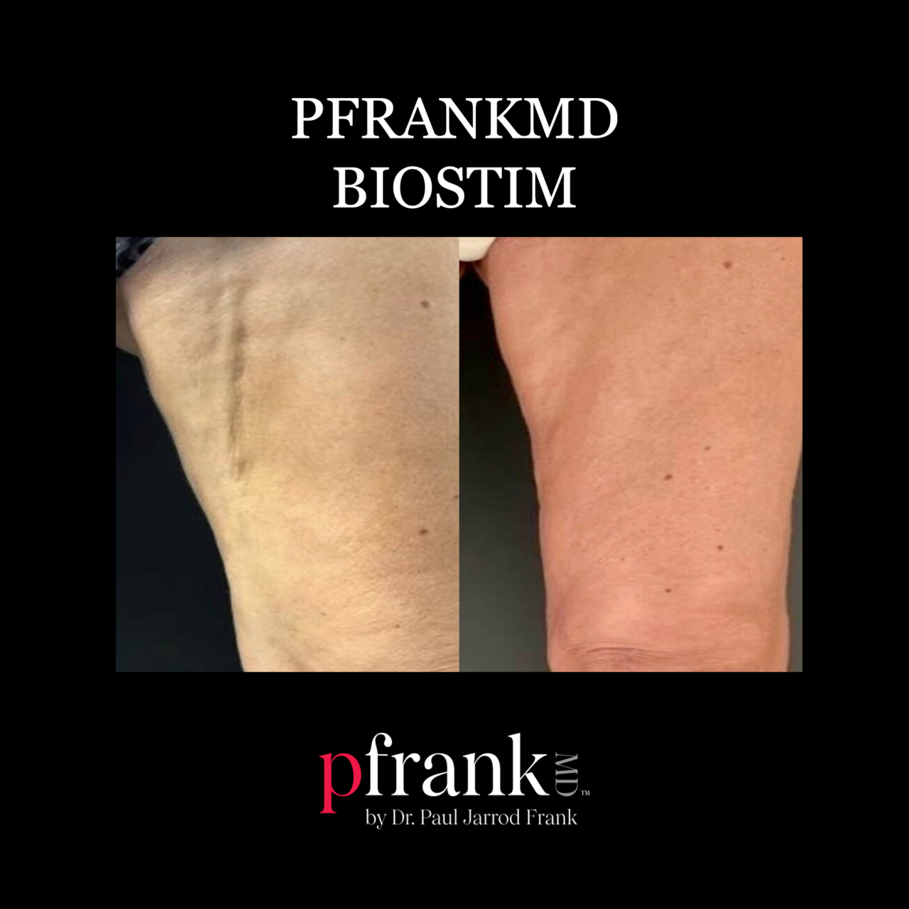 Biostim Treatments Nyc Pfrankmd By Dr Paul Jarrod Frank