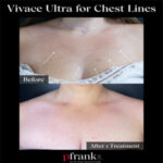 Vivace Ultra Treatment Pfrankmd By Dr Paul Jarrod Frank