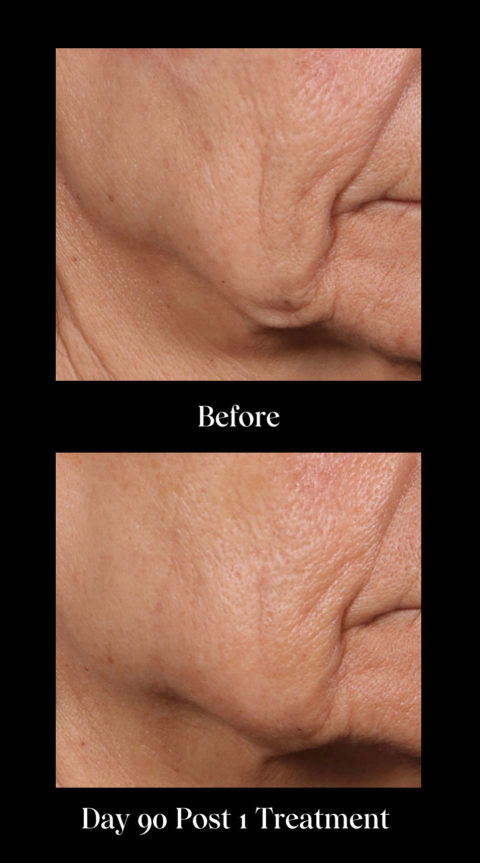 Ellacor By Cytrellis Nyc Dermal Micro Coring For Skin Tightening New York