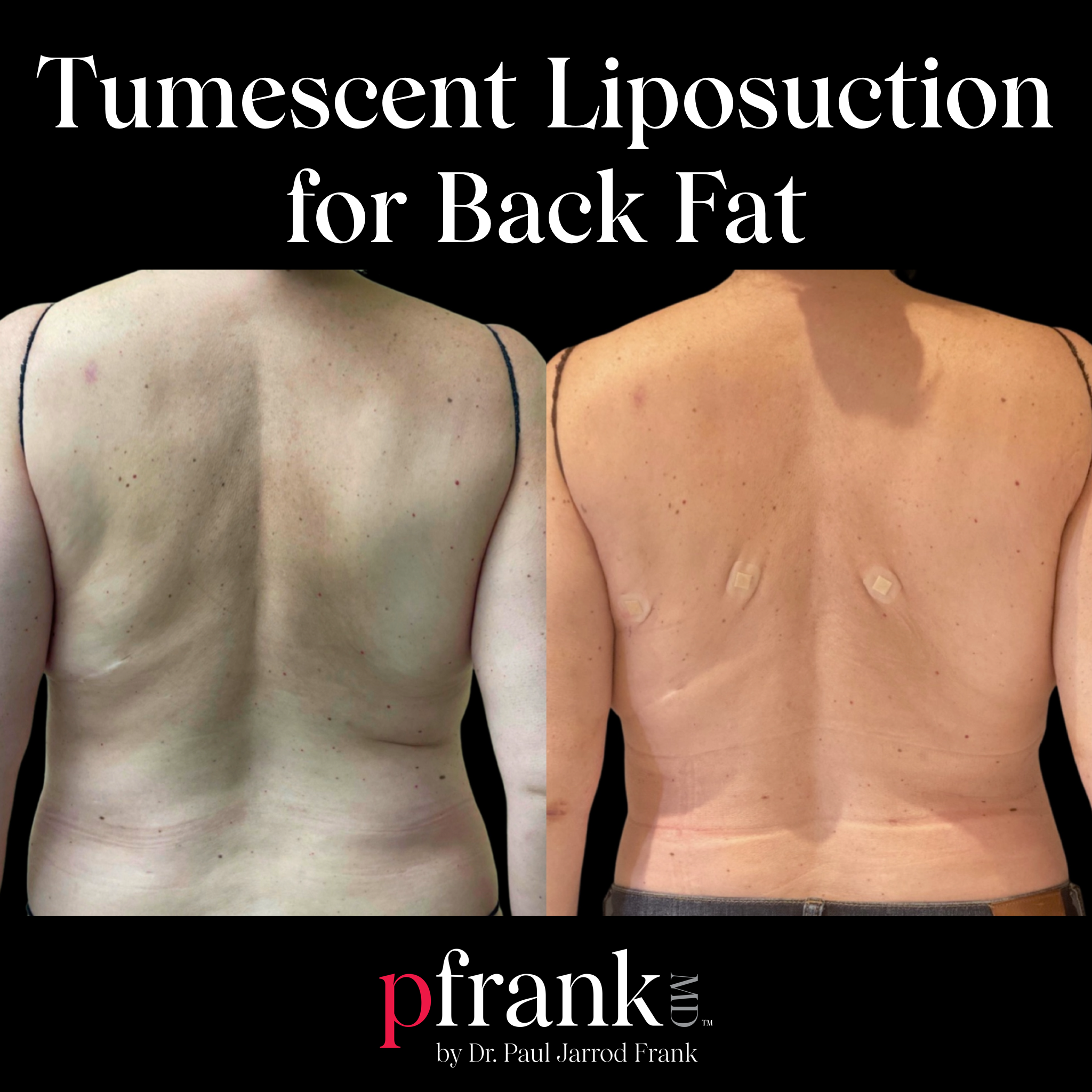Tumescent liposuction vs. Vaser