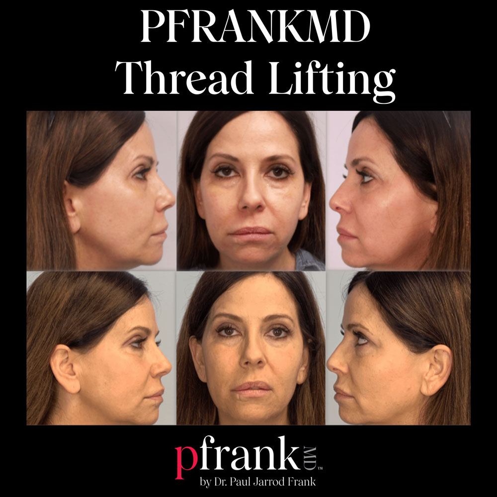 https://www.pfrankmd.com/wp-content/uploads/2023/09/pfrankmd-thread-lift-before-and-after-2.jpg