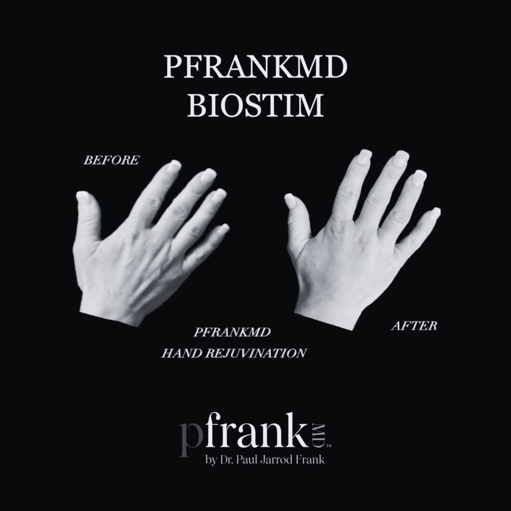 Before and after image of BioStim treatment on hands