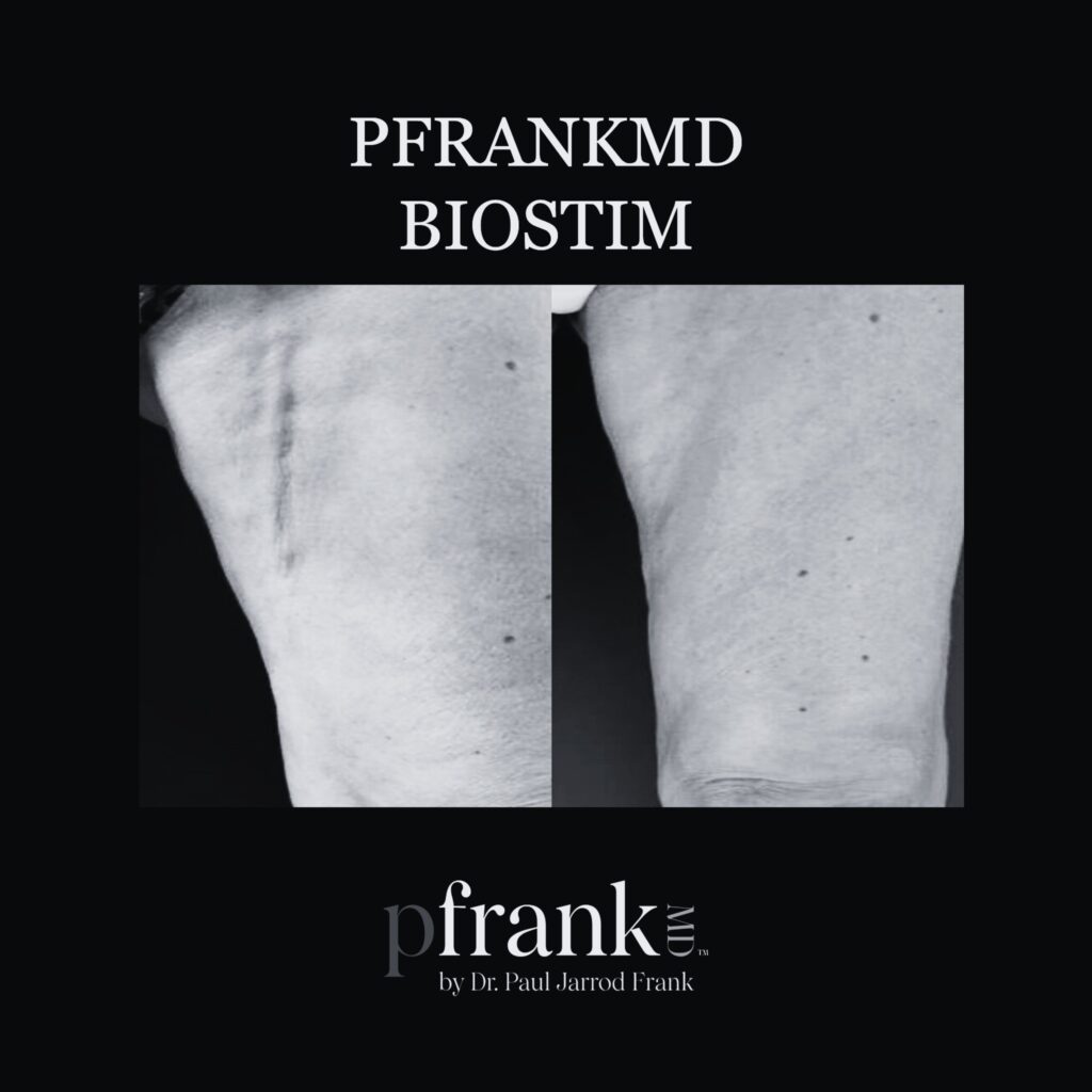 Before and after image of BioStim treatment on thigh scar - black & white