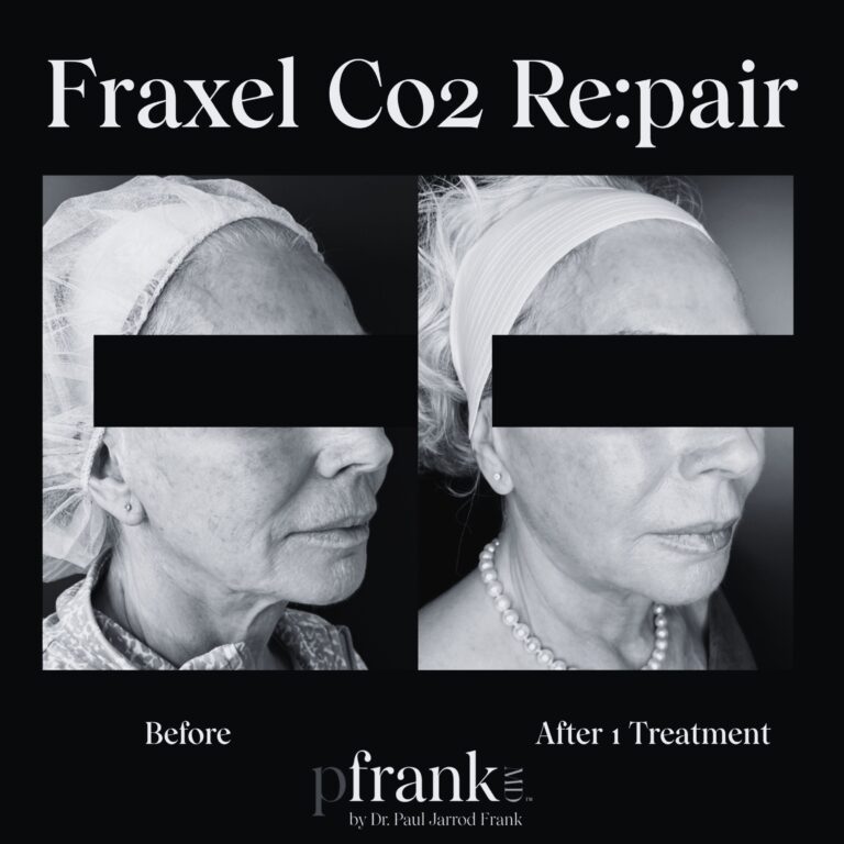 Before and after image of Fraxel CO2 treatment on right side face - black & white