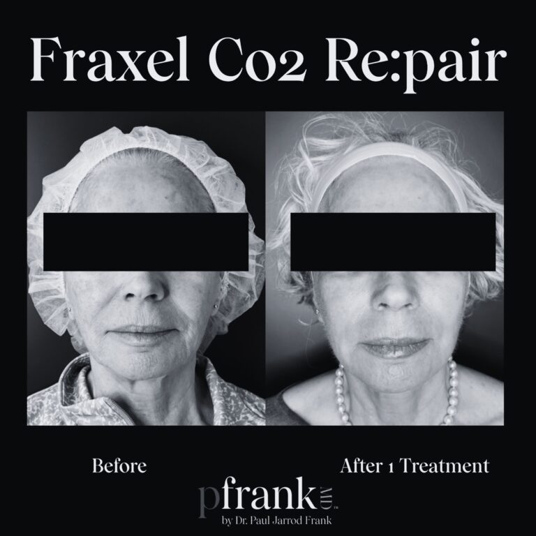 Before and after image of Fraxel CO2 treatment on front face - black & white