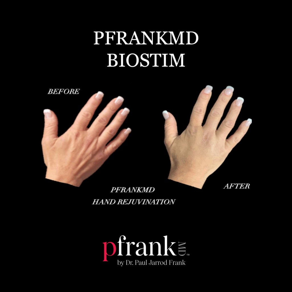 Before and after image of BioStim treatment on hands