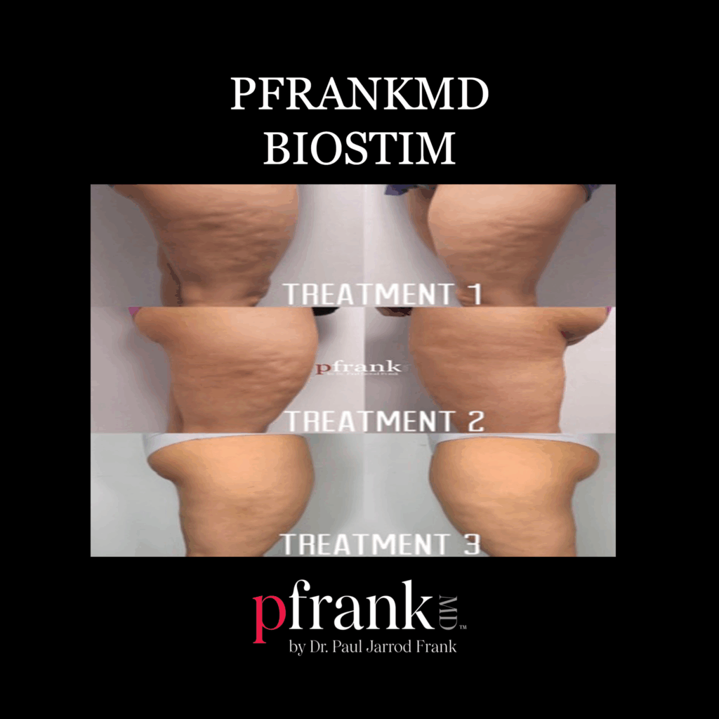 Before and after image of BioStim treatment on thigh cellulite